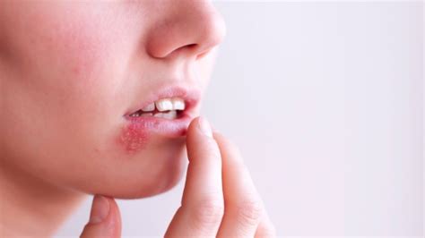 simptome herpes genital|Herpes: transmitere, simptome, diagnostic, tratament si preventie